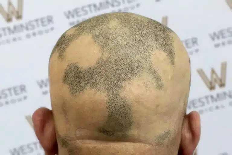 A man's head viewed from behind with a detailed map of the world hair-implanted on his scalp against a backdrop with "Westminster" logos.