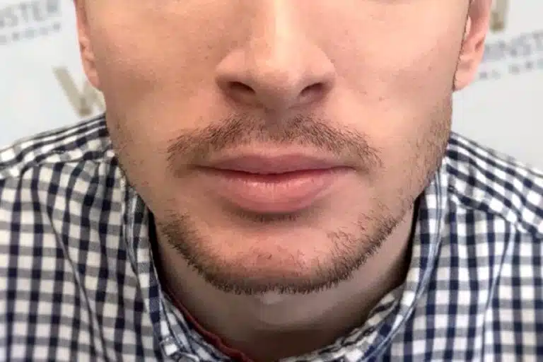 Close-up of a man's lower face showing his nose, mouth, and chin with light hair regrowth. He is wearing a plaid shirt, visible at the bottom of the image.