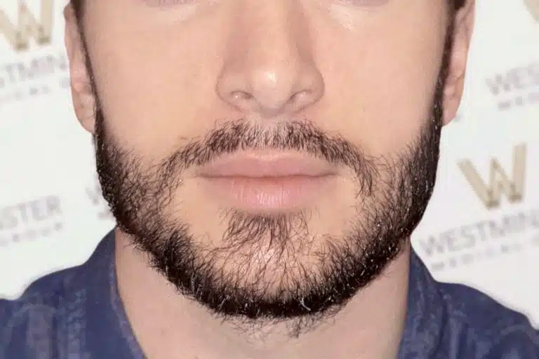 Close-up of a man's lower face showing his nose, mouth, and beard, with a blurred background featuring logos after a hair implant.
