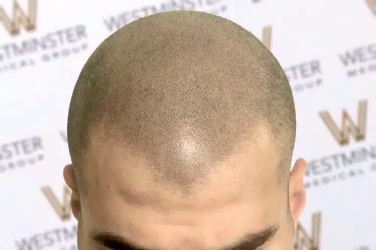 Close-up of a man’s shaved head with fine hair visible, likely showing signs of male pattern baldness, viewed from above his forehead against a backdrop with the word "westminster" repeated.