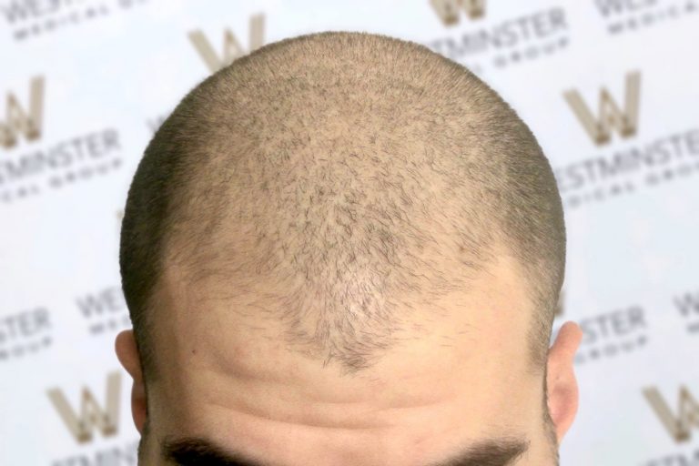 Top view of a man's head with thinning hair against a background with a repeated logo pattern, visible forehead wrinkles, and an emerging hairline suggesting the need for hair transplant services.