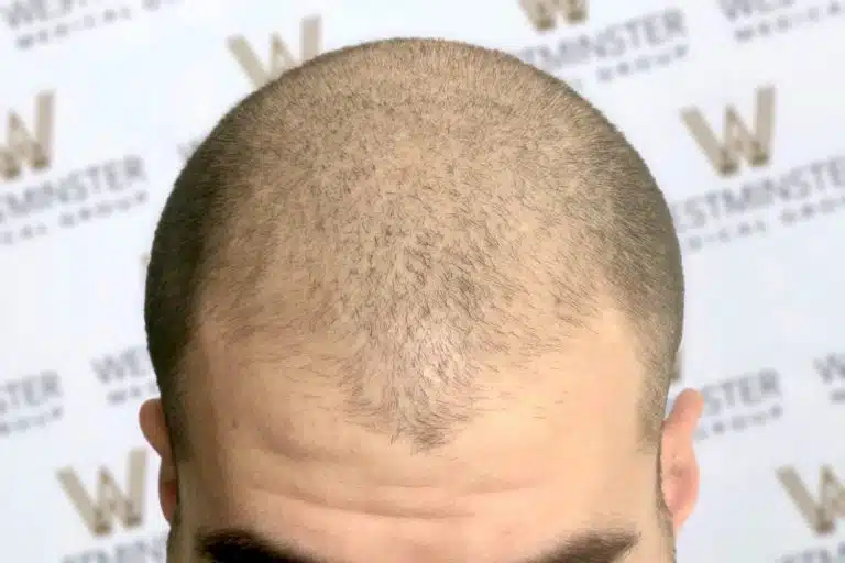 Top view of a man's head with thinning hair against a background with a repeated logo pattern, visible forehead wrinkles, and an emerging hairline suggesting the need for hair transplant services.