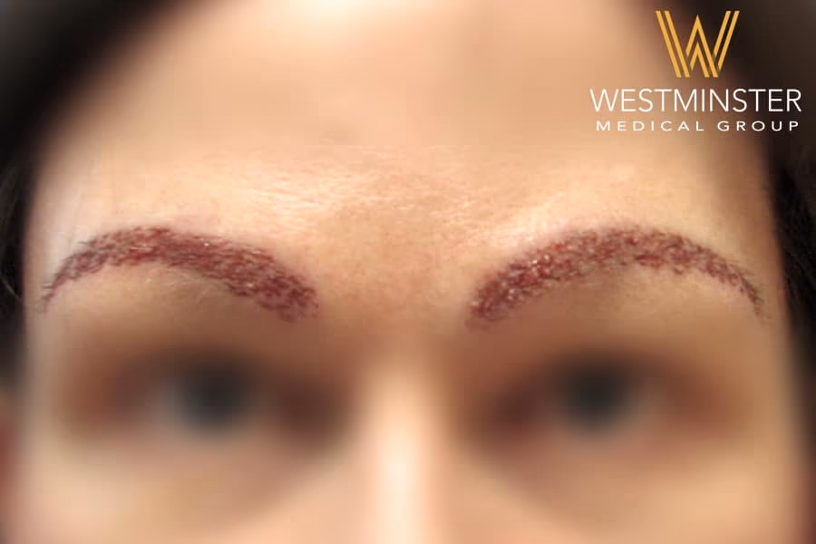 Close-up of a person’s eyes and eyebrows, with fresh microblading marks on the eyebrows. The Westminster Medical Group logo, specializing in female hair loss, is visible at the bottom.