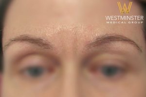 Close-up of a person's forehead and eyebrows with the logo and text "Westminster Medical Group" at the bottom, highlighting a discussion on female hair loss. The focus is soft, adding a blurred