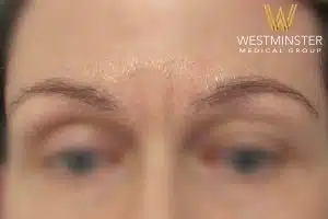 Close-up of a person's forehead and eyebrows with the logo and text "Westminster Medical Group" at the bottom, highlighting a discussion on female hair loss. The focus is soft, adding a blurred
