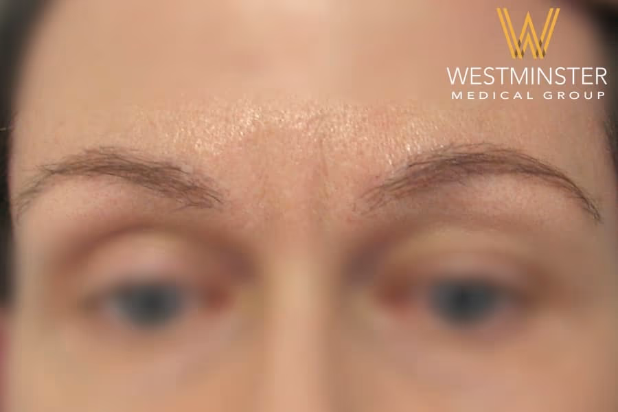Close-up of a person's forehead and eyebrows with the logo and text "Westminster Medical Group" at the bottom, highlighting a discussion on female hair loss. The focus is soft, adding a blurred