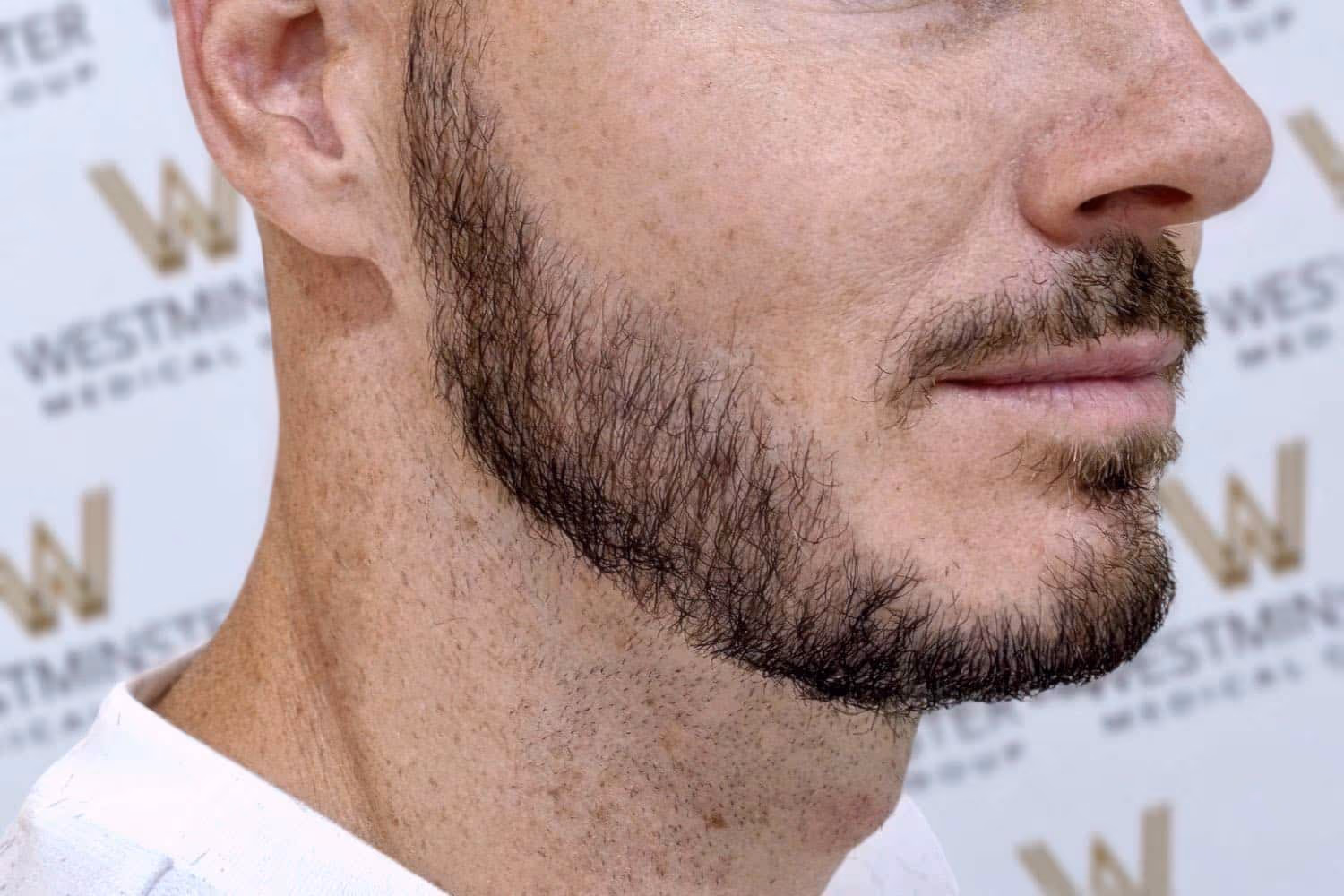 Close-up of a man's lower face showing his jawline, beard, and part of his mouth with a white shirt collar visible, against a background with a blurred text logo about hair implant.