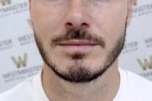 Close-up of a man's lower face showing his nose, mouth, and beard affected by male pattern baldness. The background features a pattern with the text "Westminster." The beard is neatly trimmed