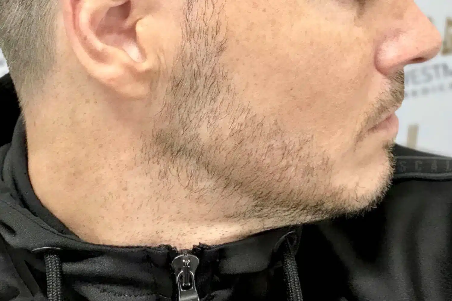 Close-up of a man's lower face and neck showing stubble, focusing on his jawline. He's wearing a black jacket with a zipper, indicative of his recovery post-hair regrowth surgery