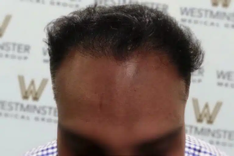 Close-up of a person's forehead showing female hair loss, with a visible scar on the forehead. Background has a patterned logo wall.