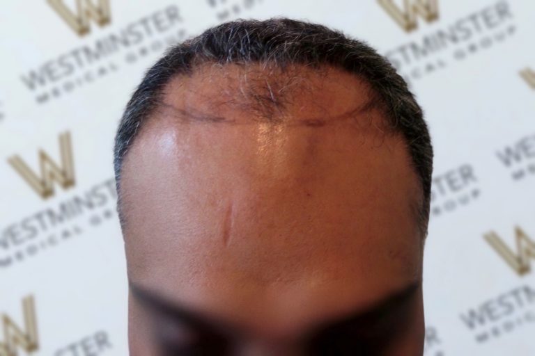 Close-up of a person's forehead showing a noticeable scar from hair implant surgery, with a blurred background featuring the repeated logo "Westminster.