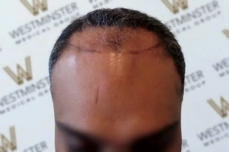 Close-up of a person's forehead showing a noticeable scar from hair implant surgery, with a blurred background featuring the repeated logo "Westminster.