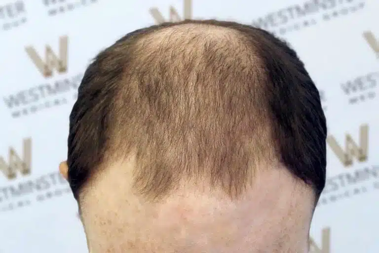 A close-up view of the back of a man's head showing hair thinning and a noticeable bald patch on the crown, characteristic of male pattern baldness. The background features a logo patterned wall
