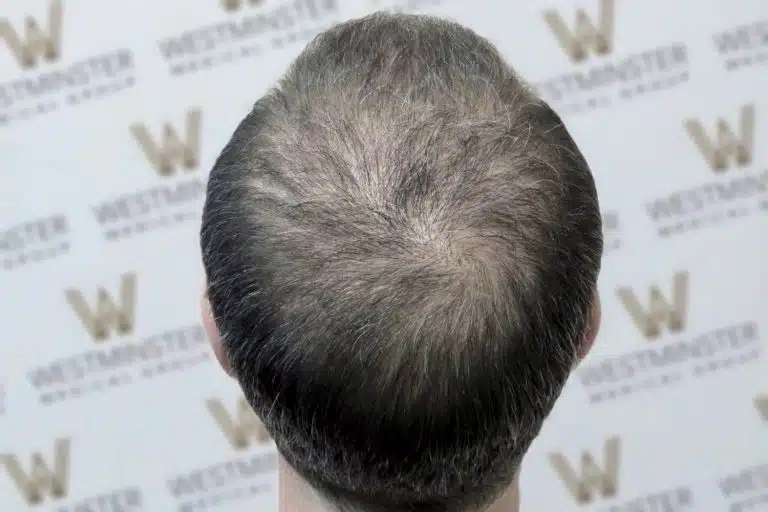 A close-up view of the back of a person's head showing thinning hair and a developing bald spot, potentially needing hair replacement, against a background with a repeated logo pattern showing the letter "w