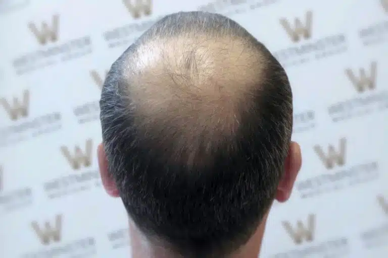 Top view of a person's head showing advanced hair loss with thinning and balding on the crown due to male pattern baldness, against a background with a repeating logo pattern.