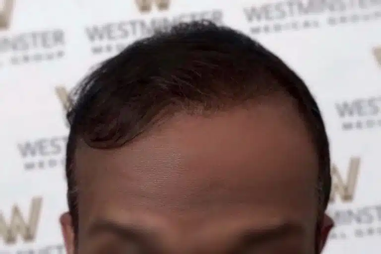 Top half of a person's face showing hairline and eyebrows after hair replacement surgery, with a blurred background displaying the "Westminster" logo.