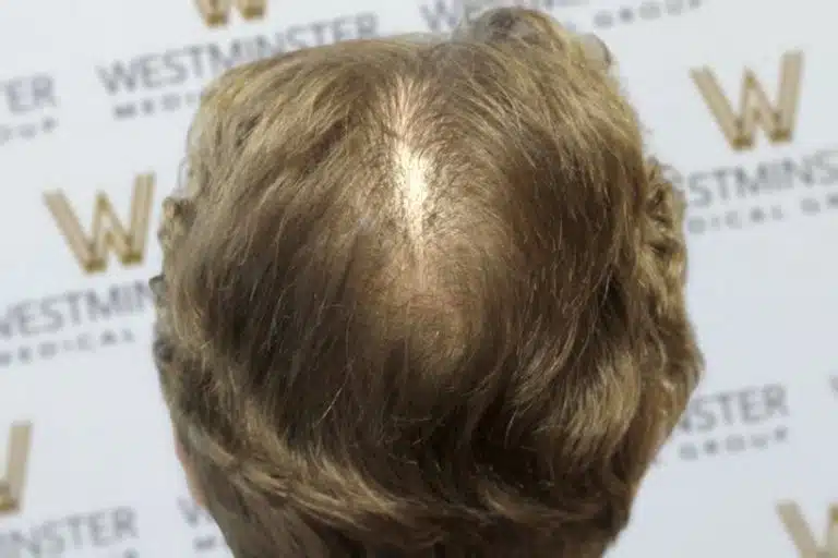 Close-up of the top of a person's head showing male pattern baldness against a backdrop with the Westminster logo.