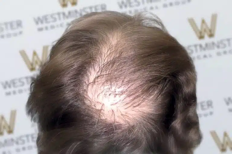Top view of a person's head showing male pattern baldness and a visible scalp, set against a backdrop with the word "westminster" repeated.