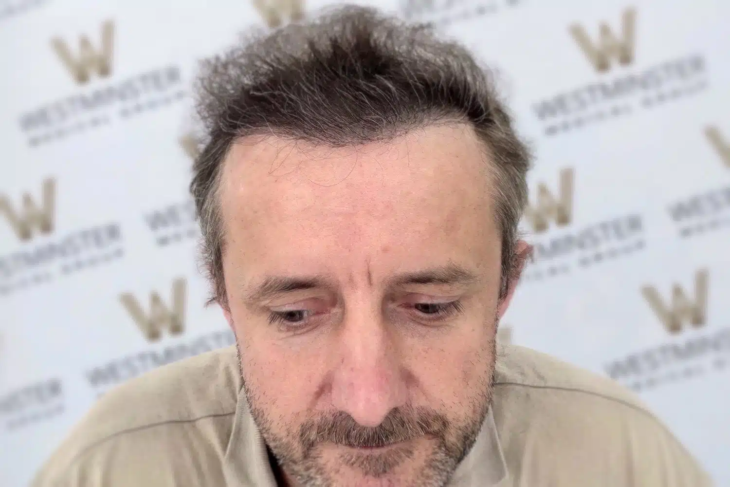 Close-up of a middle-aged man with a thoughtful expression, looking downwards. He has disheveled dark hair and is in front of a backdrop with 'Westminster' logos specializing in hair replacement.