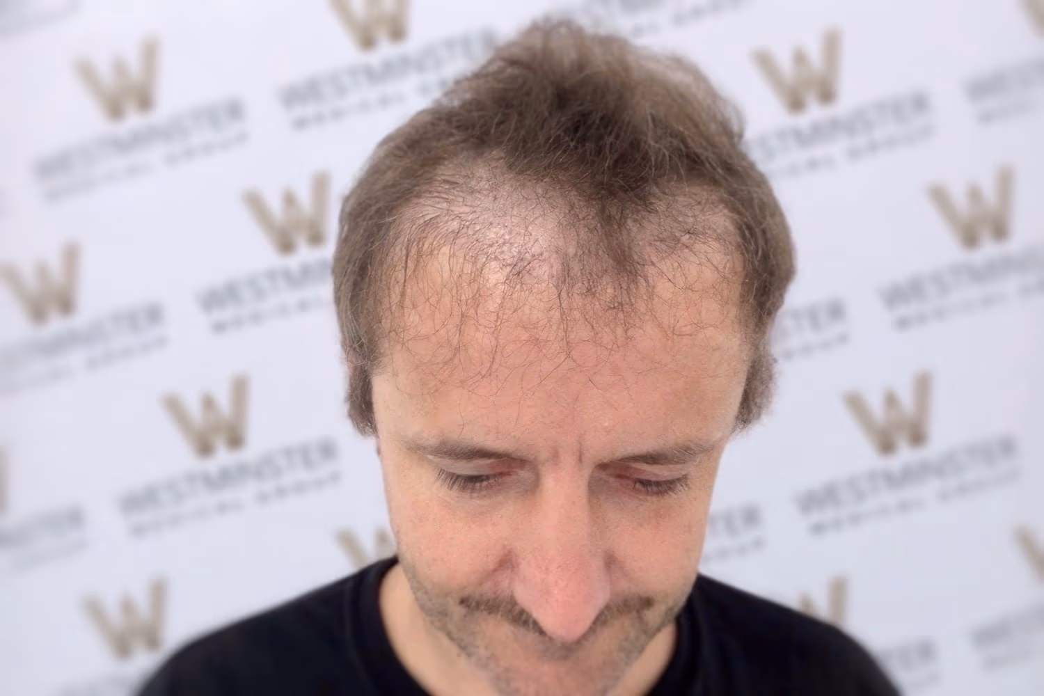 A man with signs of male pattern baldness looking downward, against a backdrop with repeated "w westminster" logos. His expression is not visible.