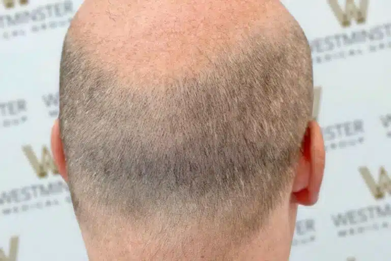 Close-up view of a male's head from behind, showcasing early stages of male pattern baldness with thinning hair and visible scalp, against a background featuring a repeated logo pattern.