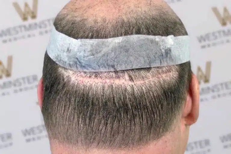 The image shows the back of a person's head post-hair implant, with visible stitches and a bandage around the head, against a backdrop with the "westminster" logo repeated.