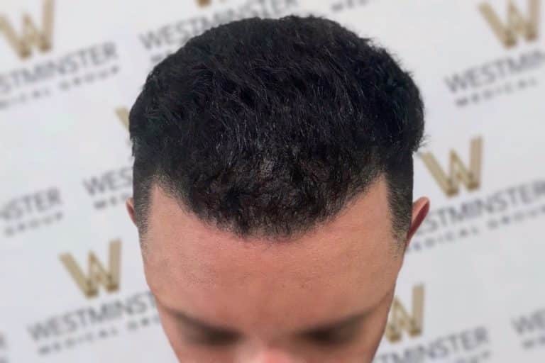 Close-up of a man's head from above, focusing on a neatly styled, short black haircut after hair replacement surgery, against a blurred background with a patterned logo.