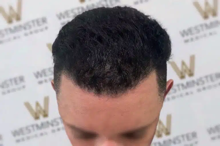 Close-up of a man's head from above, focusing on a neatly styled, short black haircut after hair replacement surgery, against a blurred background with a patterned logo.