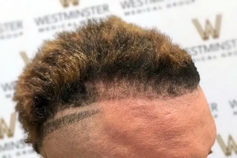 Close-up of a person's hair surgery outcome showing short, partially dyed hair with a neat, carved side-part line, against a backdrop with the 'westminster' logo repeated.