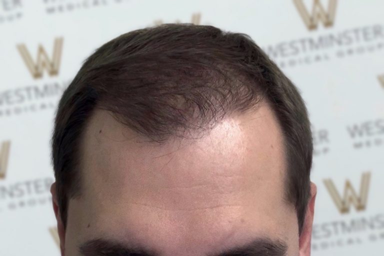 Close-up of a man's forehead and thinning hairline, indicative of male pattern baldness, against a background with the repetitive logo of "Westminster Medical Group.