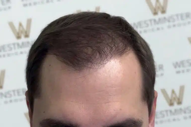 Close-up of a man's forehead and thinning hairline, indicative of male pattern baldness, against a background with the repetitive logo of "Westminster Medical Group.