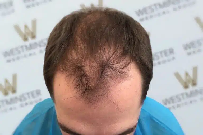 Top view of a man’s head showing male pattern baldness and a receding hairline, with a background featuring 'westminster' logos.
