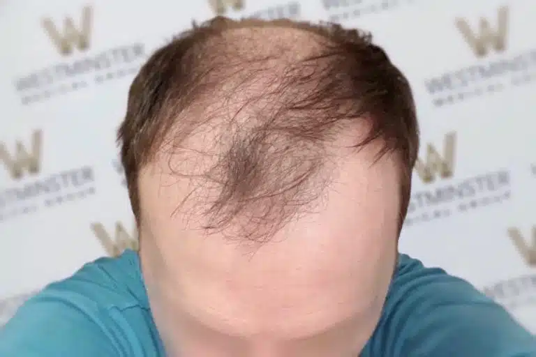 Close-up of a person's forehead showing signs of male pattern baldness, with a backdrop featuring the repeated logo of "westminster." The person is wearing a blue t-shirt.