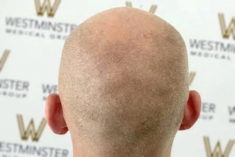 Close-up view of the back of a bald head with light stubble against a blurred background featuring the logo of Westminster Medical Group, specializing in hair implant surgery.