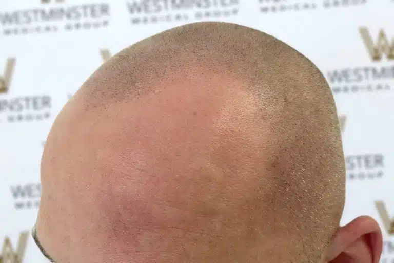 Close-up photo of the top of a bald head after hair implant surgery, showing visible hair follicles and a light reddish area of skin, against a blurred background with repeated logos.