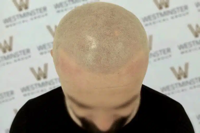 Top view of a bald head of a person experiencing female hair loss, with subtle shadow and texture, positioned against a background with repeated logo patterns.