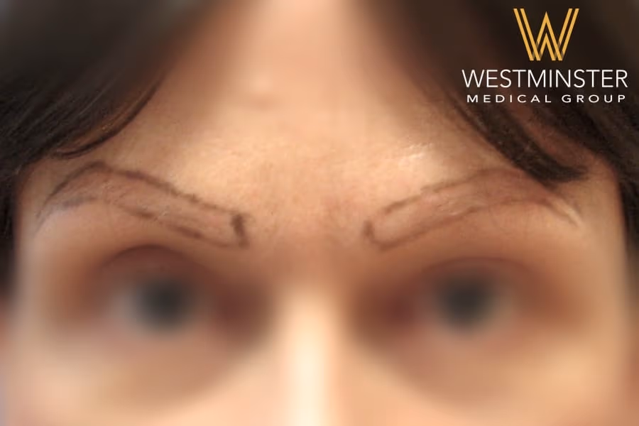 Close-up of a person’s forehead showing eyebrows with black marker lines for a hair replacement procedure. The image is partially blurred, with the "Westminster Medical Group" logo in the top right corner.