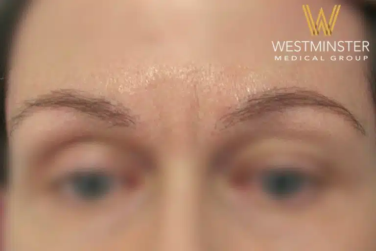 Close-up of a person's forehead and eyebrows with the logo of Westminster Medical Group at the bottom center, following hair implant surgery. The image is slightly blurred towards the edges.