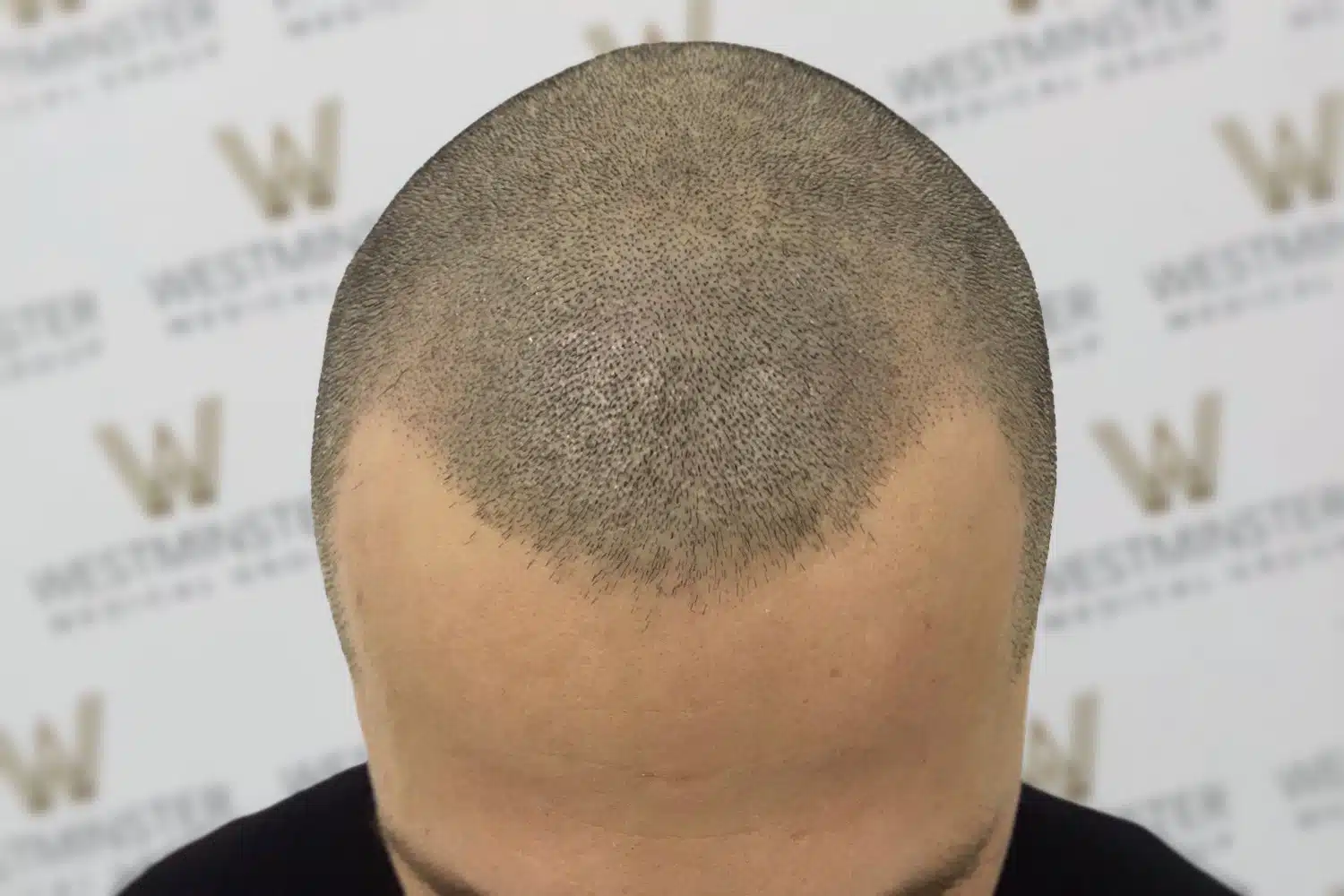 Close-up of a man's head from the back, showing early stages of hair growth with a distinct pattern of male pattern baldness on a partially bald scalp. The background features a logo-covered wall.