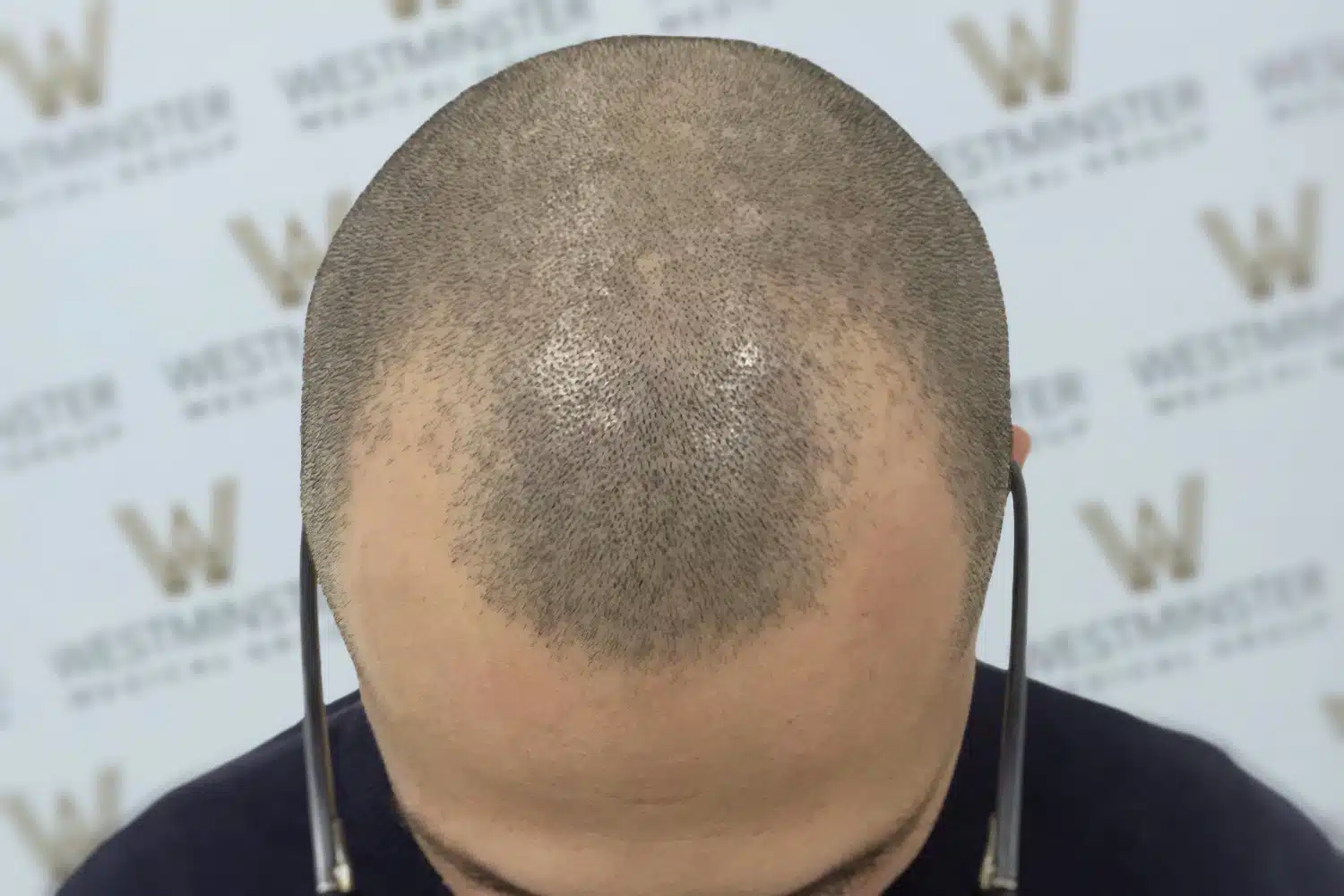 Top view of a balding man's head showing thinning hair and scalp, against a background with a patterned logo of "Westminster". The focus is sharp on the head, highlighting areas ideal