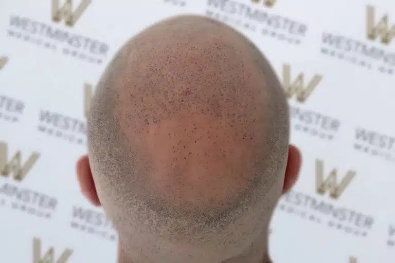 Back view of a bald person's head with light stubble and a few freckles, standing against a backdrop marked repeatedly with "westminster," illustrating hair loss.