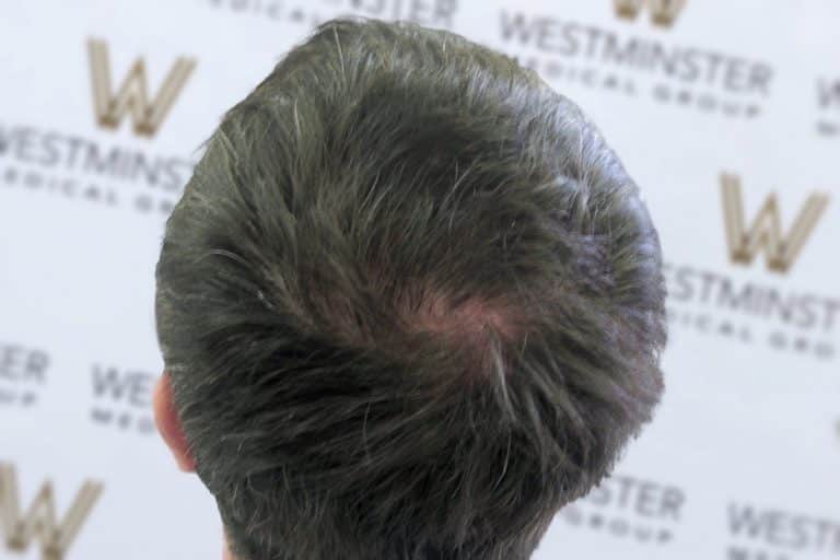 Top view of a person's head showing a bald spot with thinning dark hair, indicative of female hair loss, against a backdrop bearing the Westminster logo.