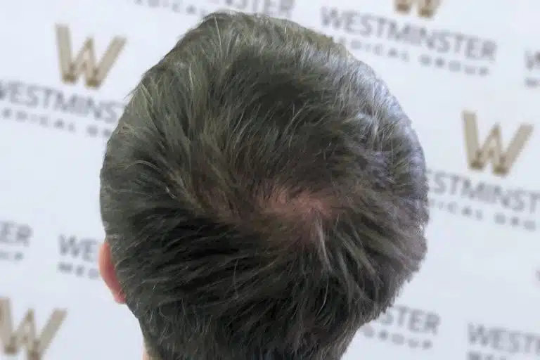 Top view of a person's head showing a bald spot with thinning dark hair, indicative of female hair loss, against a backdrop bearing the Westminster logo.