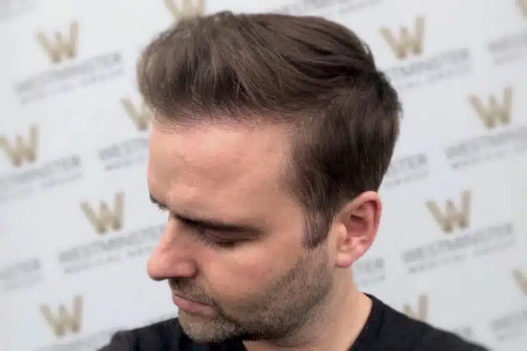 Side view of a man with a trendy hair implant, featuring short sides and a longer, textured top, against a backdrop with a logo repeated in a pattern.