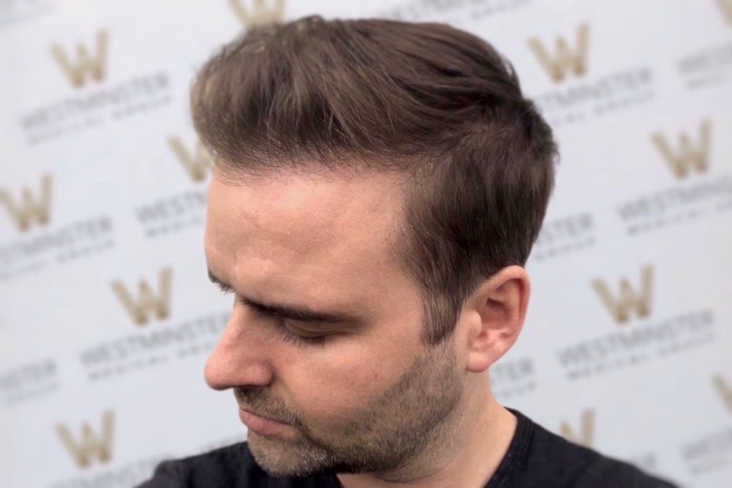 Side view of a man with a trendy hair implant, featuring short sides and a longer, textured top, against a backdrop with a logo repeated in a pattern.