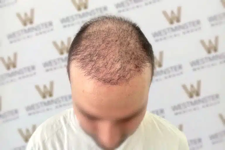 Close-up view of a man's head showing early stages of hair loss on the top and front areas, against a background with a repeated logo pattern for hair replacement services.