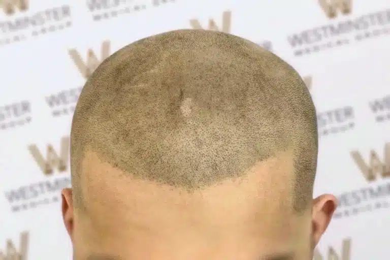 Close-up of the top of a person's head showing a unique hair pattern with a shaved design resembling an inverted heart, set against a backdrop with the "westmaster" logo. This image highlights the