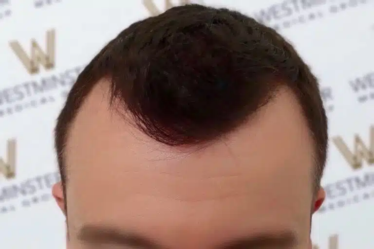 Close-up of a man's forehead and hairline, featuring dark hair styled upwards after a hair implant, with no visible face except the forehead, against a branded background.