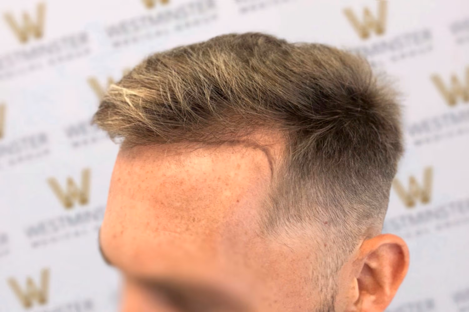 fue hair transplant london