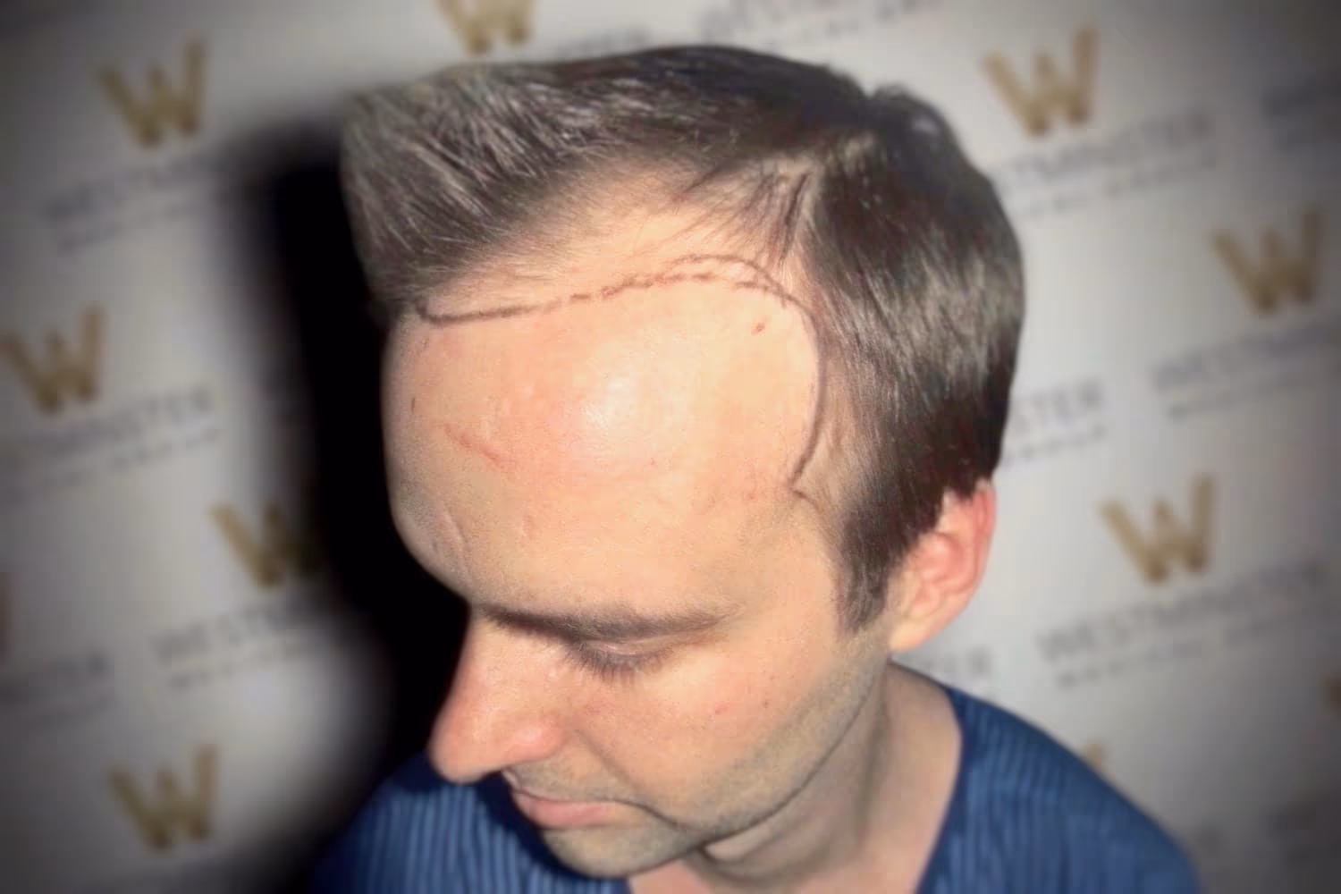 A man with marked lines on his scalp possibly for a hair implant procedure, standing against a backdrop with a repetitive "w" pattern.